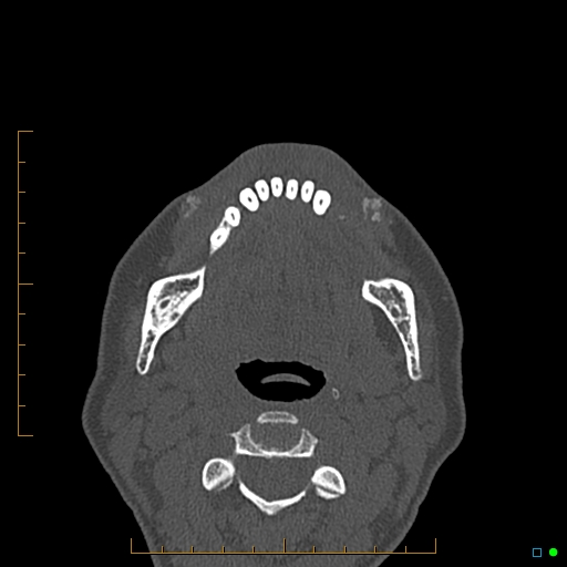 Calcified facial augmentation fillers (Radiopaedia 79514-92679 Axial bone window 127).jpg