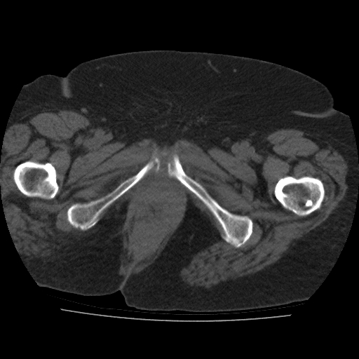 File:Calcified fibroids (Radiopaedia 16853-16579 non-contrast 21).jpg