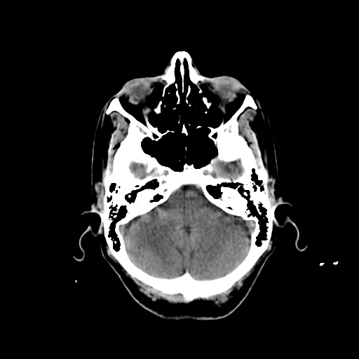 File:Calcified meningioma - cervical canal (Radiopaedia 70136-80171 Axial non-contrast 7).jpg
