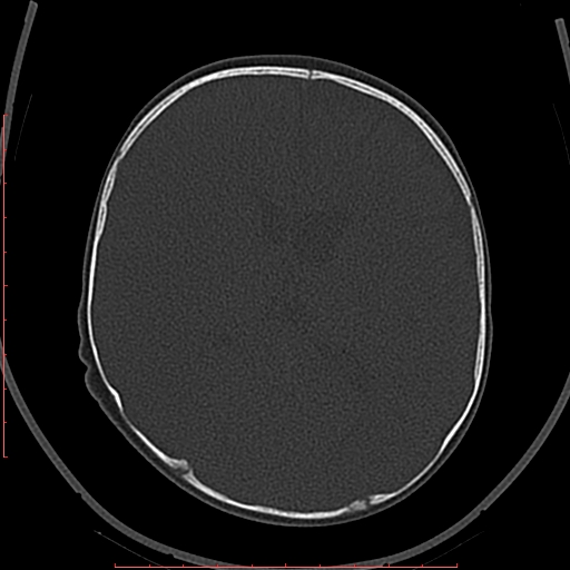 Calcified middle cerebral artery embolism (Radiopaedia 78949-91860 Axial bone window 38).jpg