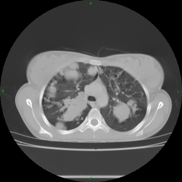 File:Cannon ball metastases - synovial sarcoma (Radiopaedia 26135-26271 Axial lung window 13).jpg
