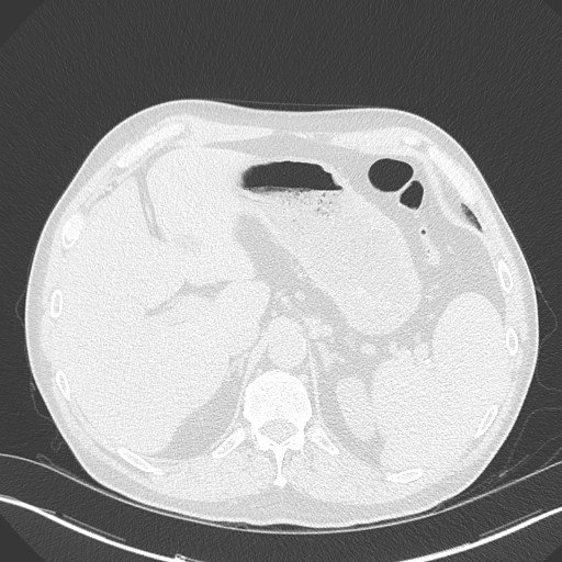 Caplan syndrome (Radiopaedia 56667-63530 Axial lung window 187).jpg
