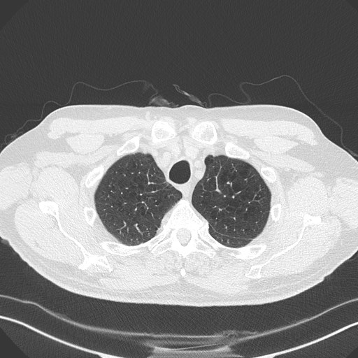 Caplan syndrome (Radiopaedia 56667-63530 Axial lung window 38).jpg