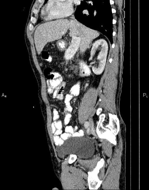 Caput medusae sign - portal hypertension (Radiopaedia 64007-72759 B 28).jpg