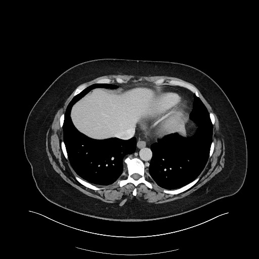 Carcinoid tumor - terminal ileum (Radiopaedia 60931-68739 A 13).jpg