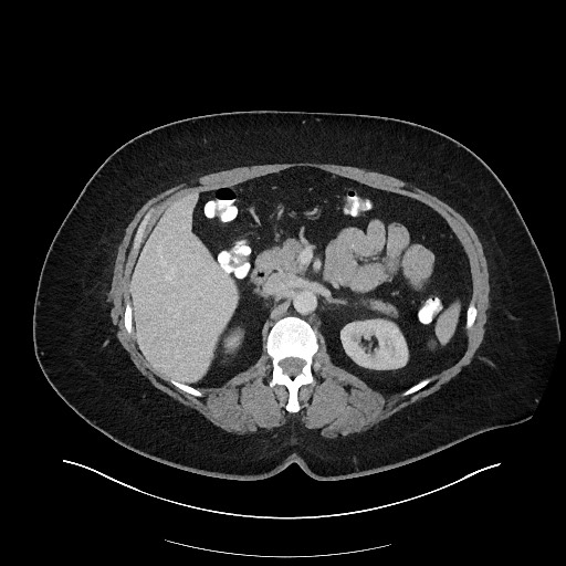 File:Carcinoid tumor - terminal ileum (Radiopaedia 60931-68739 Axial 47).jpg