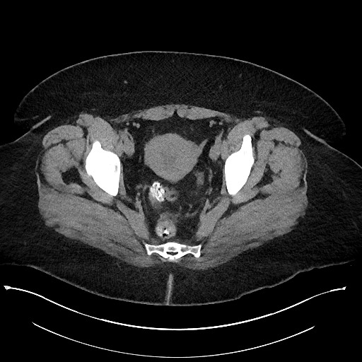 Carcinoid tumor - terminal ileum (Radiopaedia 60931-68740 Axial non-contrast 109).jpg