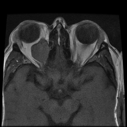 File:Carcinoid tumor of the ileum with metastasis to orbit (Radiopaedia 28165-28424 Axial T1 5).jpg