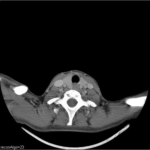 Carcinoma of the maxillary antrum (Radiopaedia 53805-59888 Axial C+ delayed 7).jpg