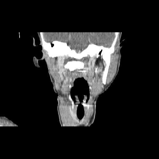 Carcinoma of the maxillary antrum (Radiopaedia 53805-59888 Coronal C+ delayed 95).jpg