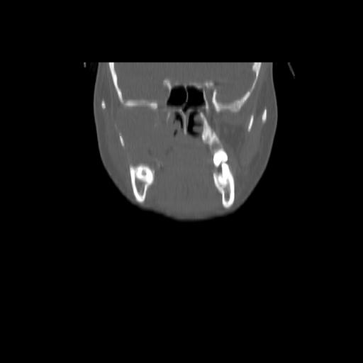 Carcinoma of the maxillary antrum (Radiopaedia 53805-59888 Coronal bone window 55).jpg