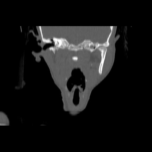 Carcinoma of the maxillary antrum (Radiopaedia 53805-59888 Coronal bone window 85).jpg