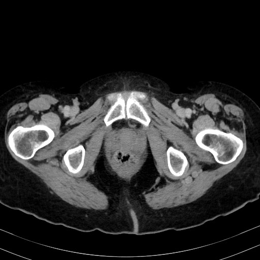 Carcinosarcoma (Radiopaedia 70401-80503 A 70).jpg