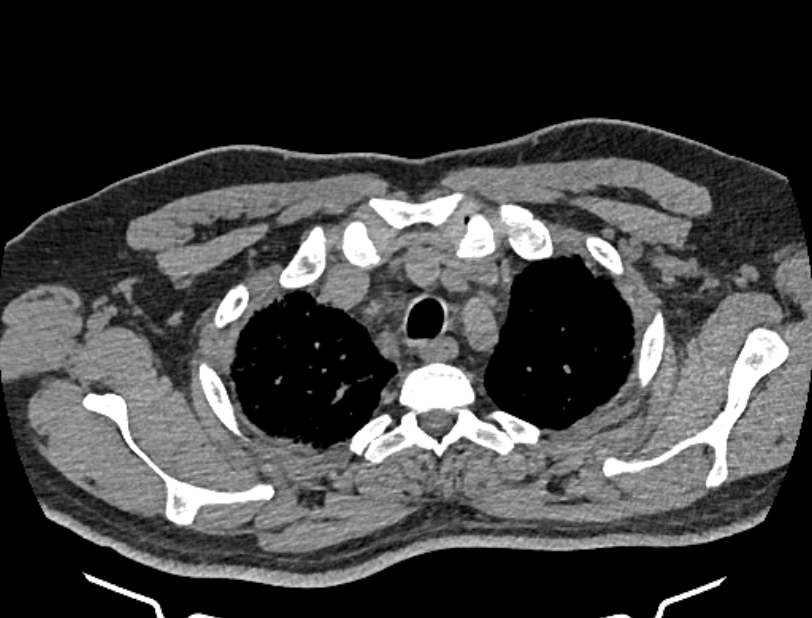 Cardiogenic pulmonary edema (Radiopaedia 68180-77678 Axial non-contrast 6).jpg