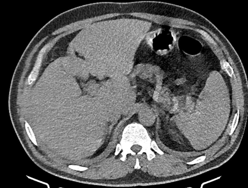 Cardiogenic pulmonary edema (Radiopaedia 68180-77678 Axial non-contrast 61).jpg
