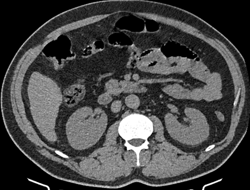 Cardiogenic pulmonary edema (Radiopaedia 68180-77678 Axial non-contrast 80).jpg