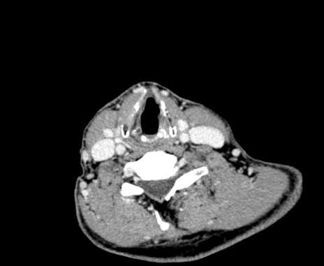 File:Carotid body tumor (Radiopaedia 61750-69757 Axial Post contrast 80).jpg
