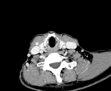 File:Carotid body tumor (Radiopaedia 61750-69757 Axial Post contrast 88).jpg