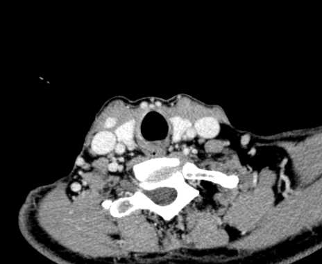 Carotid body tumor (Radiopaedia 61750-69757 Axial Post contrast 96).jpg