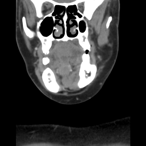 File:Carotid body tumor (paraganglioma) (Radiopaedia 38586-40729 B 11).jpg