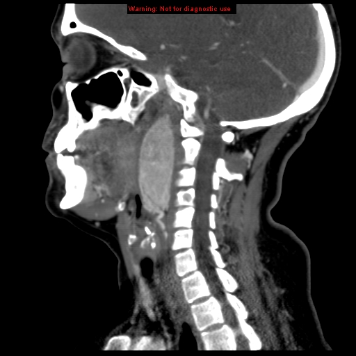 File:Carotid body tumor with lung metastases (Radiopaedia 9301-9986 Sagittal C+ delayed 30).jpg
