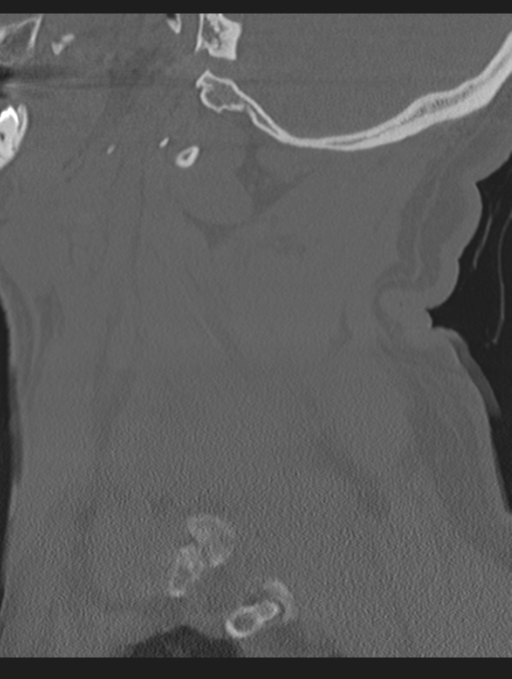 Cavernoma of cervical cord (Radiopaedia 50838-56346 Sagittal bone window 18).png