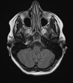 File:Cavernoma with bleed - midbrain (Radiopaedia 54546-60774 Axial FLAIR 7).png