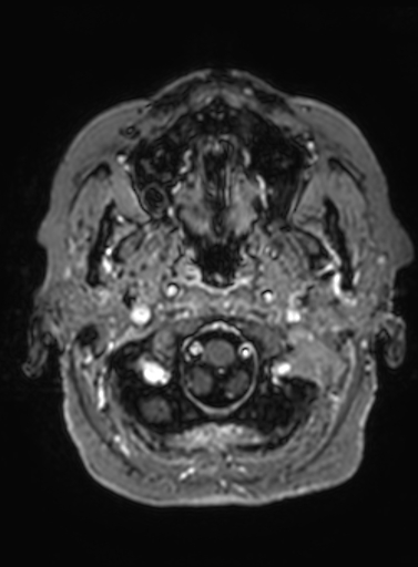 Cavernous hemangioma of the cerebellar falx (Radiopaedia 73025-83724 Axial T1 C+ 317).jpg