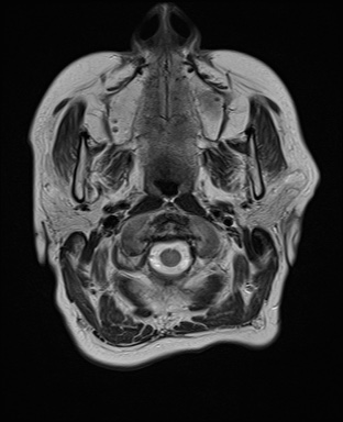 File:Cavernous sinus meningioma (Radiopaedia 63682-72367 Axial T2 1).jpg
