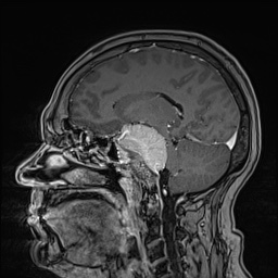 Cavernous sinus meningioma (Radiopaedia 63682-72367 Sagittal T1 C+ 81).jpg