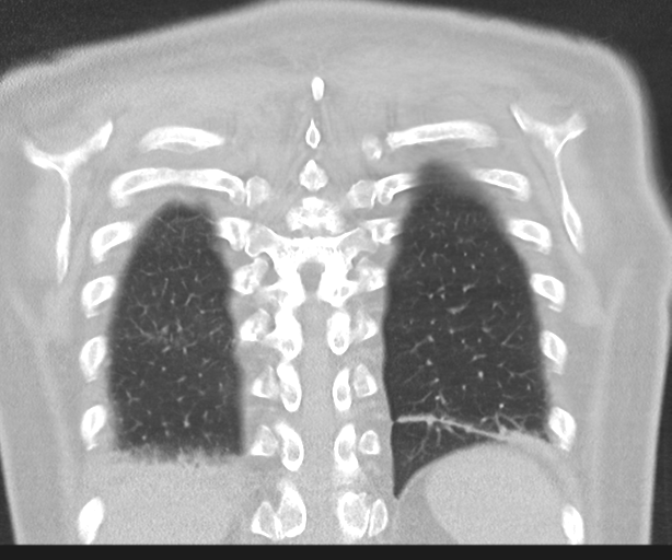 Cavitating pneumonia (Radiopaedia 45998-50329 Coronal lung window 41).png