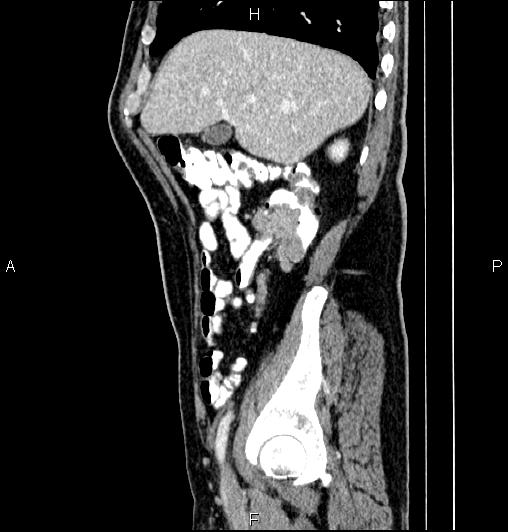 Cecal adenocarcinoma (Radiopaedia 85324-100916 E 22).jpg