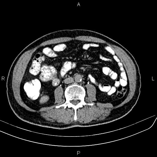 File:Cecal cancer with appendiceal mucocele (Radiopaedia 91080-108651 Axial C+ delayed 36).jpg