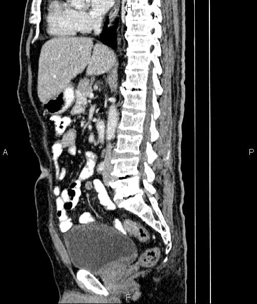 File:Cecal cancer with appendiceal mucocele (Radiopaedia 91080-108651 E 48).jpg
