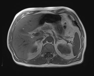 File:Cecal mass causing appendicitis (Radiopaedia 59207-66532 Axial T1 in-phase 42).jpg