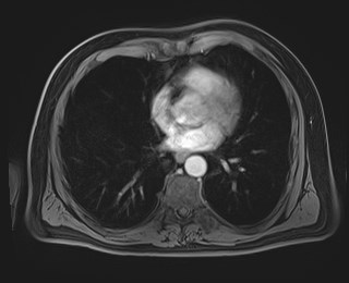 Cecal mass causing appendicitis (Radiopaedia 59207-66532 T1 C+ PV phase 10).jpg