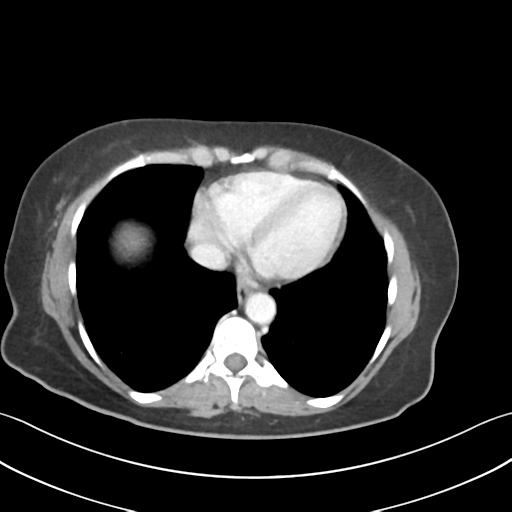 File:Cecum hernia through the foramen of Winslow (Radiopaedia 46634-51112 A 5).png