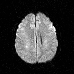 File:Central-variant posterior reversible encephalopathy syndrome (PRES) (Radiopaedia 43880-47358 Axial DWI 15).jpg