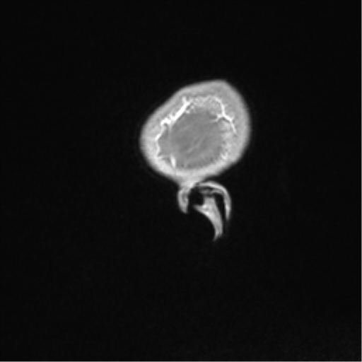 Central neurocytoma (Radiopaedia 37664-39557 Sagittal T1 C+ 6).png