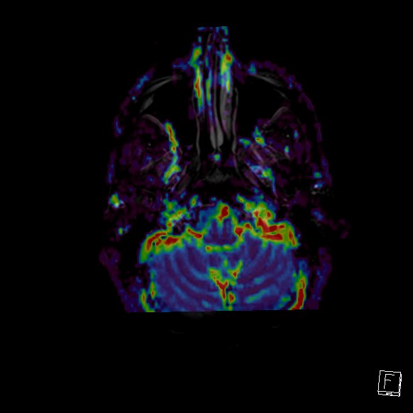 Central neurocytoma (Radiopaedia 84497-99872 Axial Perfusion 280).jpg