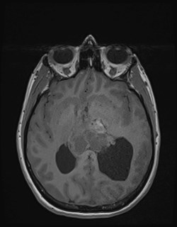 Central neurocytoma (Radiopaedia 84497-99872 Axial T1 103).jpg