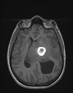 Central neurocytoma (Radiopaedia 84497-99872 Axial T1 112).jpg