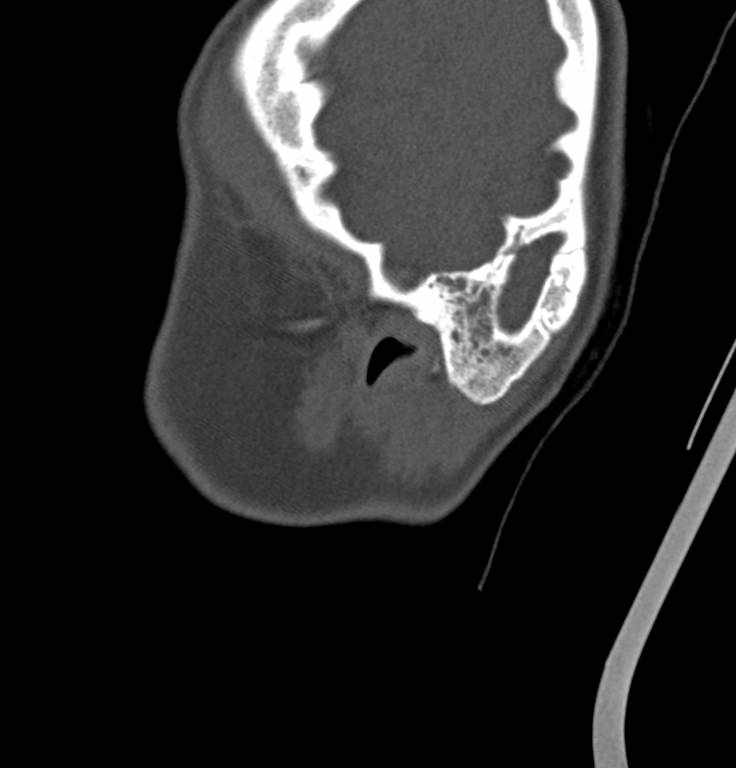 Cerebellar abscess (Radiopaedia 73727-84527 Sagittal bone window 40).jpg