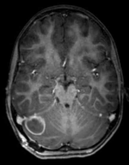 Cerebellar abscess (Radiopaedia 73727-84563 Axial T1 C+ fat sat 54).jpg