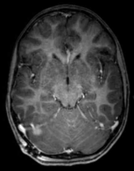 Cerebellar abscess (Radiopaedia 73727-84563 Axial T1 C+ fat sat 57).jpg