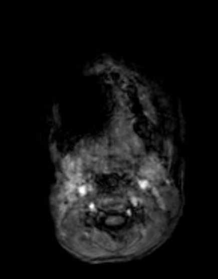 Cerebellar abscess (Radiopaedia 73727-84563 Axial T1 C+ fat sat 9).jpg