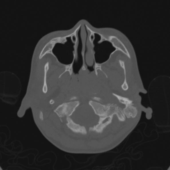 Cerebellar abscess secondary to mastoiditis (Radiopaedia 26284-26413 Axial bone window 17).jpg