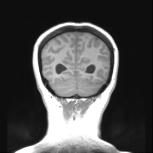 Cerebellar ependymoma complicated by post-operative subdural hematoma (Radiopaedia 83322-97736 Coronal T1 48).png