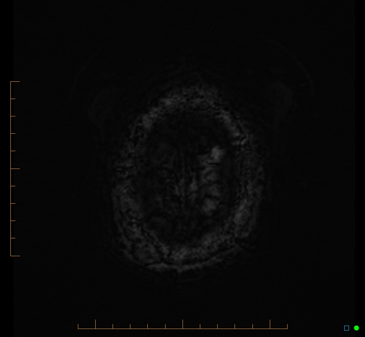 Cerebellar gangliocytoma (Radiopaedia 65377-74422 Axial SWI 59).jpg