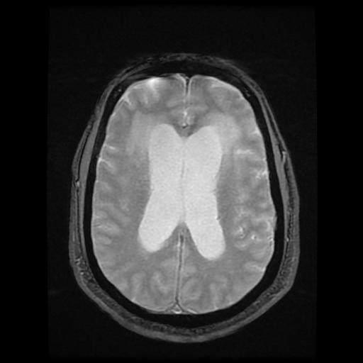 File:Cerebellar hemangioblastoma (Radiopaedia 88055-104622 Axial Gradient Echo 13).jpg
